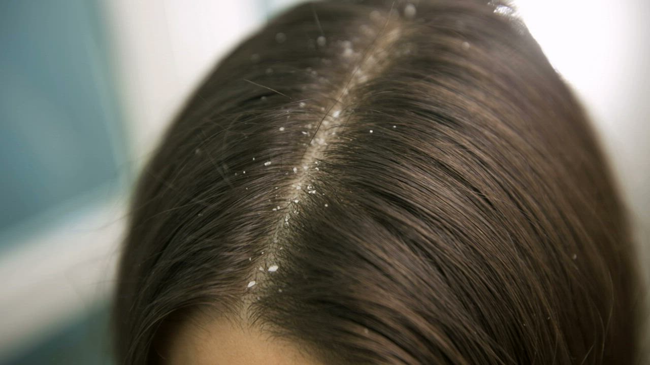 Read more about the article Top 12 Free Anti-Dandruff  Hair Solution