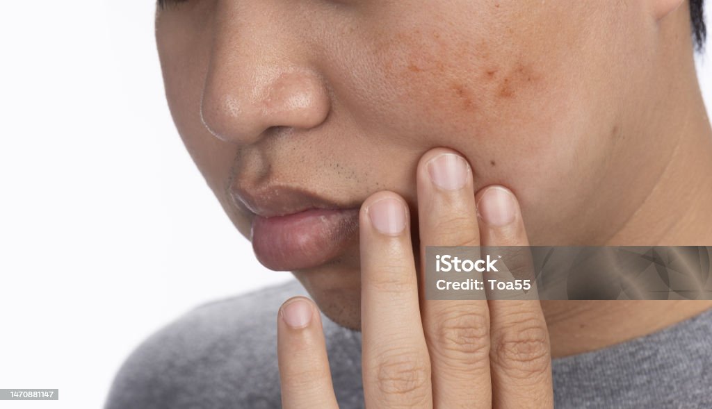 How to remove dark spots from your skin with ayurvedic solution